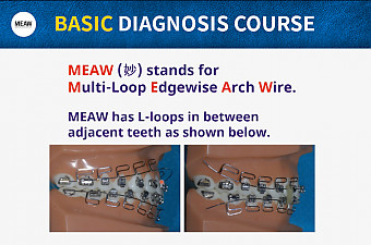 Orthodontics - Multi-Loop Edgewise Archwire (MEAW) MEAW
