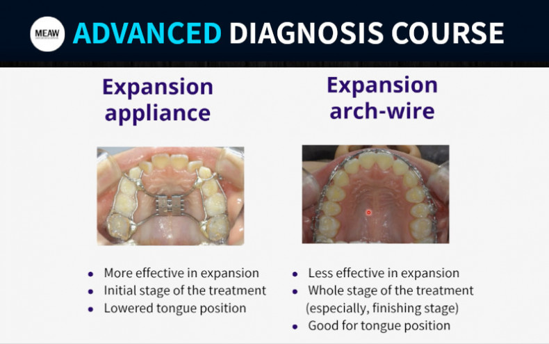 Arch Expansion in Orthodontics: What is it?